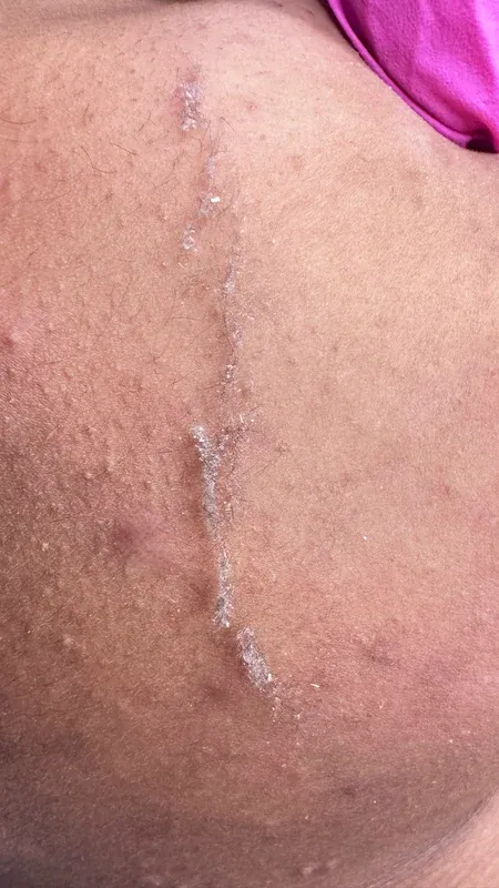 Pele do rosto durante o dermaplaning, com a lâmina removendo células mortas e pelos finos